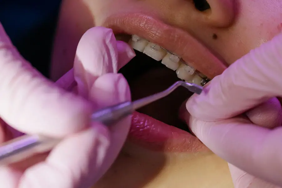 Dettaglio di un trattamento odontoiatrico con strumenti di precisione